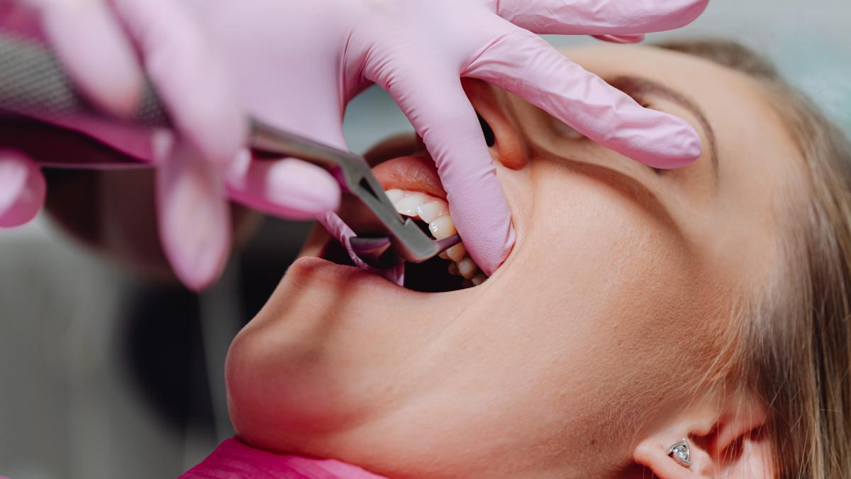 plomba-dentara--cand-este-necesara_23970700