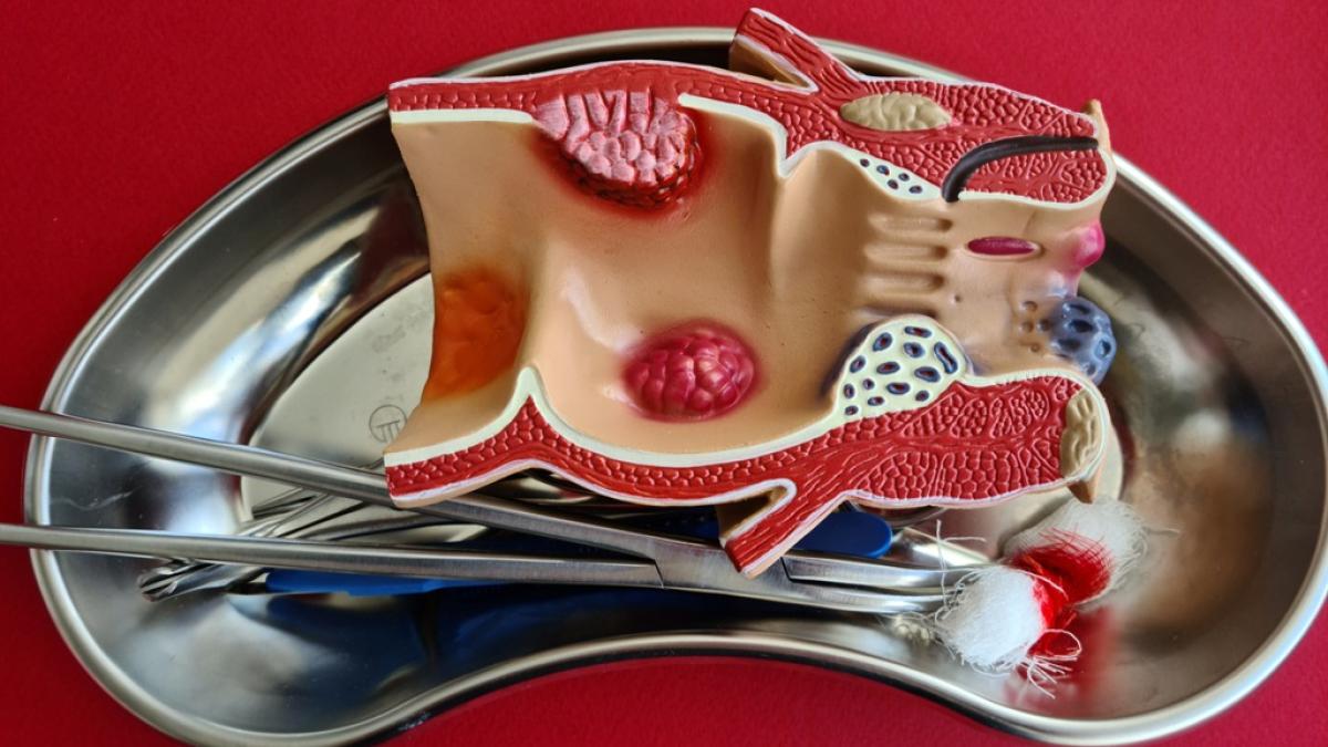 cancerul-colorectal--tratament-modern_58876500