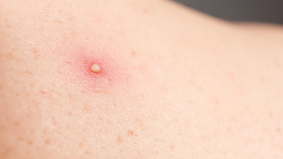 furunculul--infectia-firelor-de-par_16558700