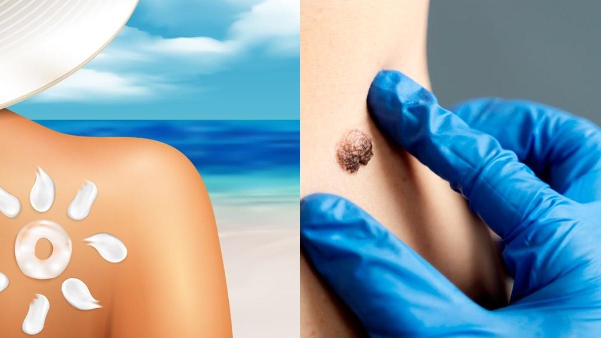 cancerul-de-piele--date-ingrijoratoare_83822200