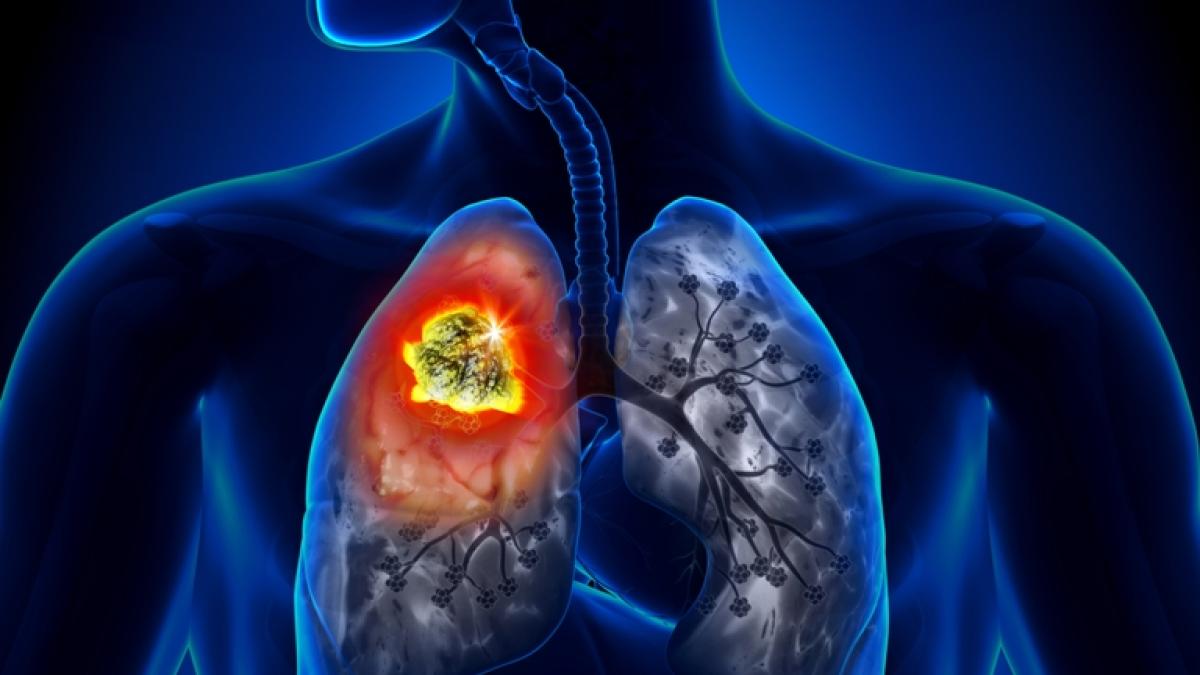 tuberculoza--cauze--simptome-si-tratament_54992800