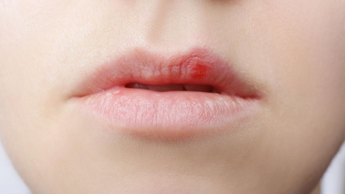 planta-care-te-scapa-de-herpes--lidia-fecioru-se-retrage-instantaneu_55494500