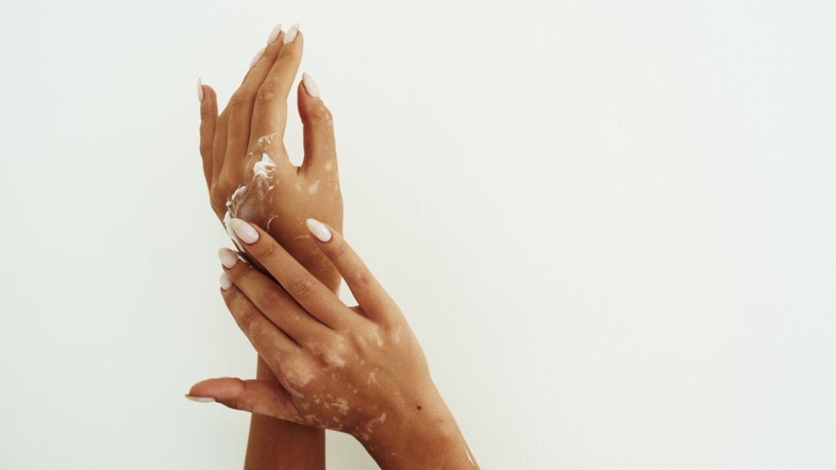 opzelura--tratament-revolutionar-pentru-vitiligo_79986500