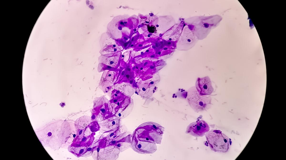 meningiomul--cancerul-frecvent-al-femeilor--ce-este--unde-se-dezvolta-si-ce-simptome-are--gramescu-am-observat-ca-se-malignizeaza-mai-repede-decat-inainte_42084500