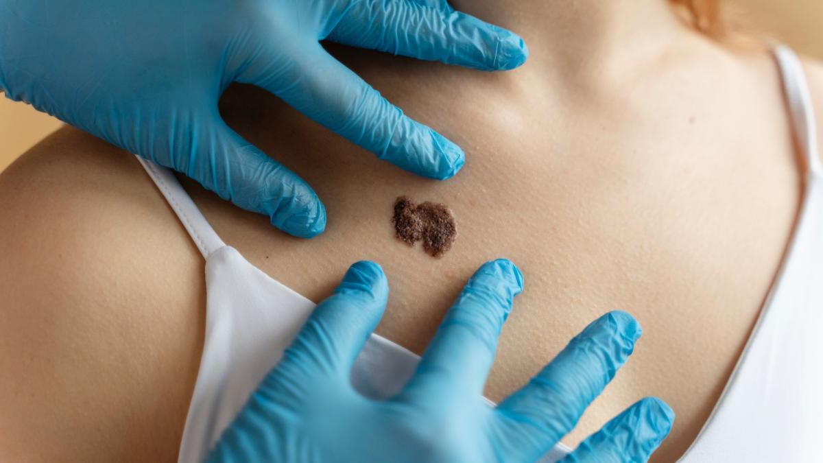 melanomul--mai-putin-frecvent--dar-mai-periculos--dr--simionescu-rata-sa-de-supravietuire-este-cea-mai-sumbra_64673500