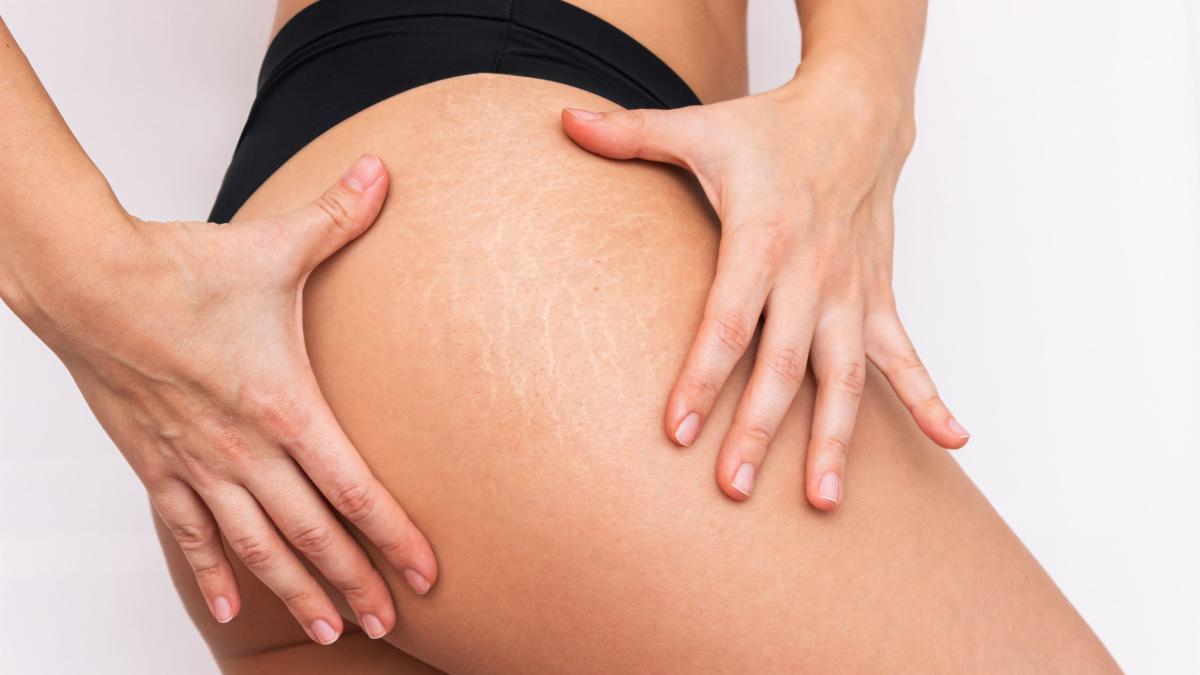 mituri-si-adevaruri-despre-vergeturi--dermatolog-nu-avem-cum-sa-le-rezolvam-absolut_94440500