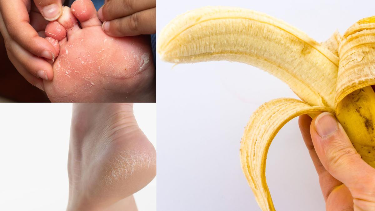 calcaie-crapate--talpi-uscate--cauze-si-remedii--patru-solutii-geniale-de-facut-acasa--trebuie-sa-incerci-trucul-cu-banane_94228500