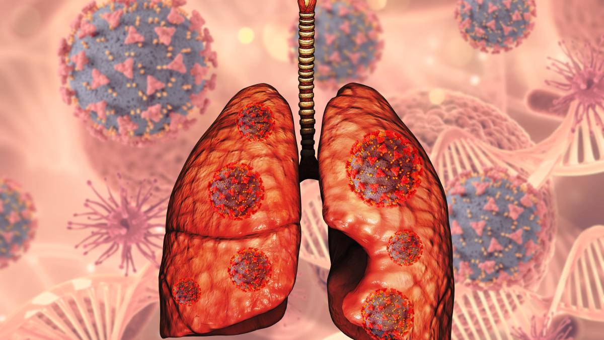 abcesul-pulmonar--dificil-de-tratat_76447000
