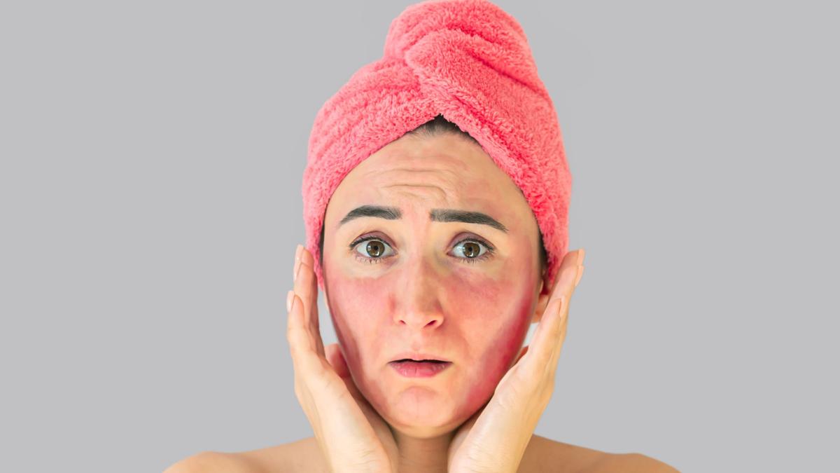 cuperoza--cauze-si-tratament--dermatolog-stresul-psiho-emotional--factor-agravant_23619300