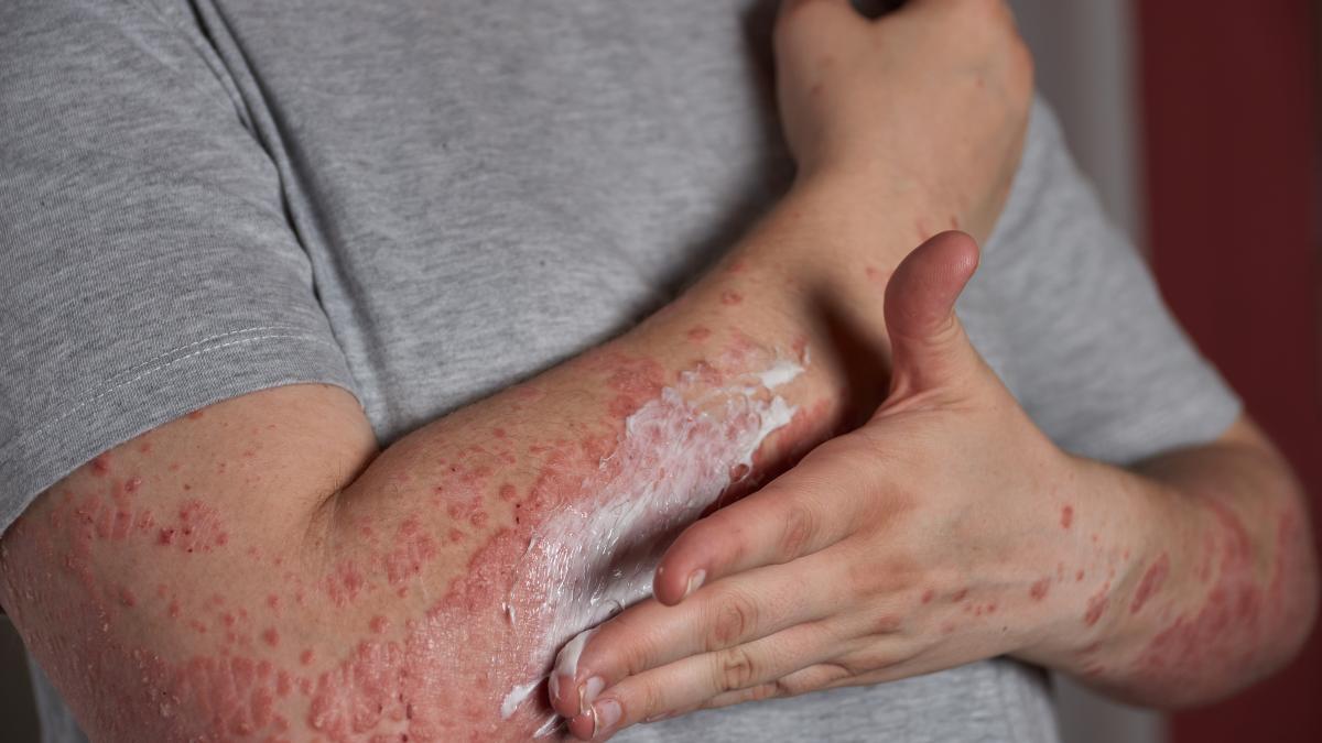 psoriazisul--efect-si-asupra-psihicului_99305400