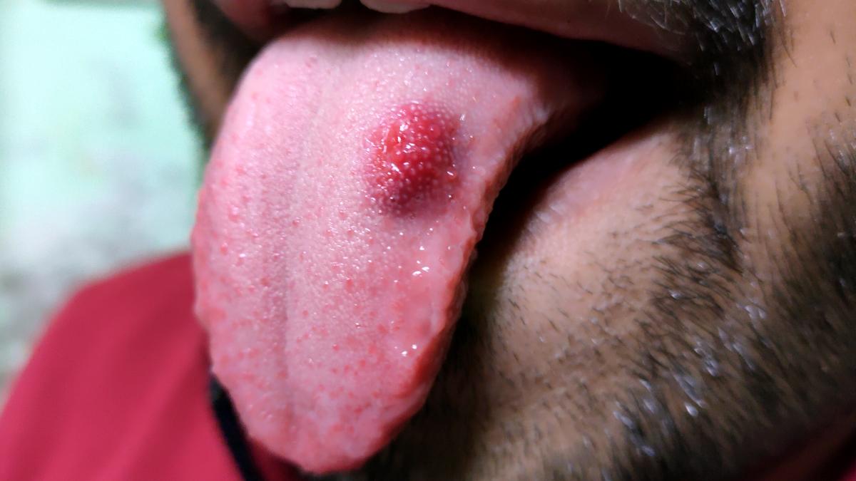 cancerul-oral--cresteri-alarmante_02525800