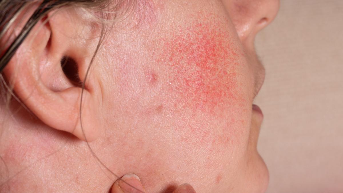 explozie-de-boli-si-cancere-de-piele--greseala-zilnica-ce-ne-distruge--semnul-de-pe-piele-ca-ai-helicobacter-pylori-foarte-grav-e-ca-a-crescut-melanomul_59334500
