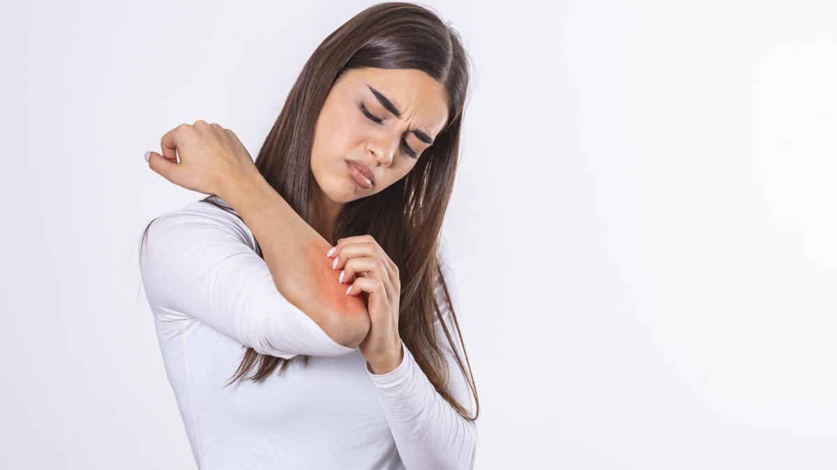 urticaria--mancarimea-pielii--cauze-si-simptome_27427500