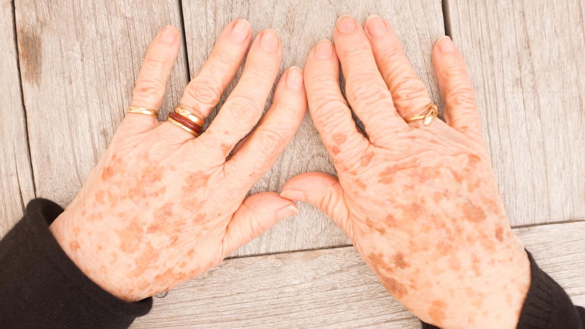 pielea-si-reactiile-dupa-tratamentele-oncologice--dermatolog-se-intampla-extrem-de-frecvent--cam-la-80prc--dintre-pacienti_69534500
