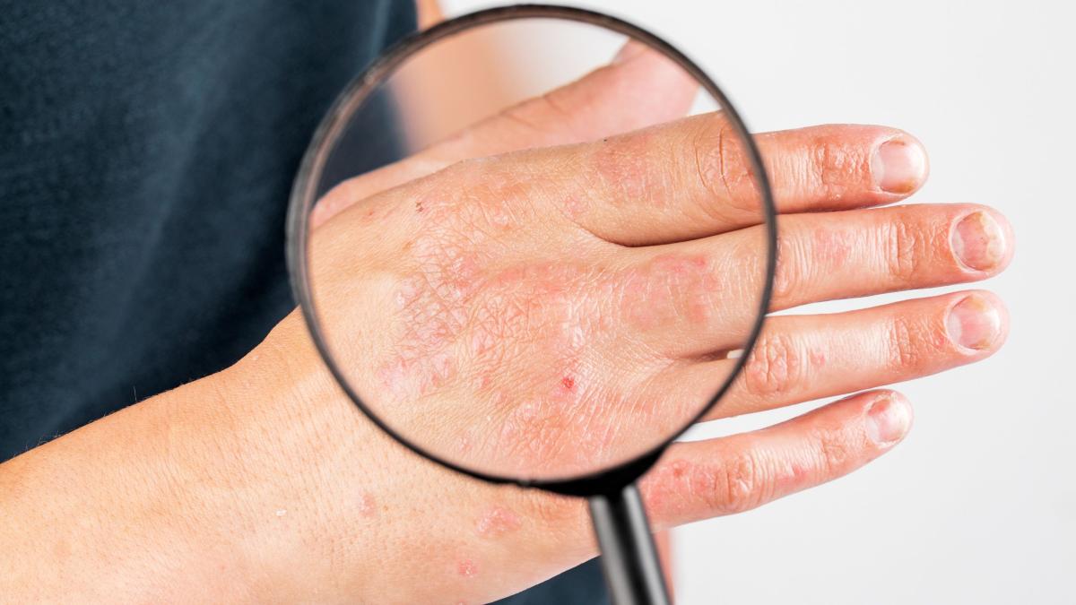 dermatita-herpetiforma--boala-duhring--cauze--simptome-si-tratament--badea-sunt-cel-mai-intolerant-la-gluten--eu-si-alti-cativa-de-la-planeta_86662500