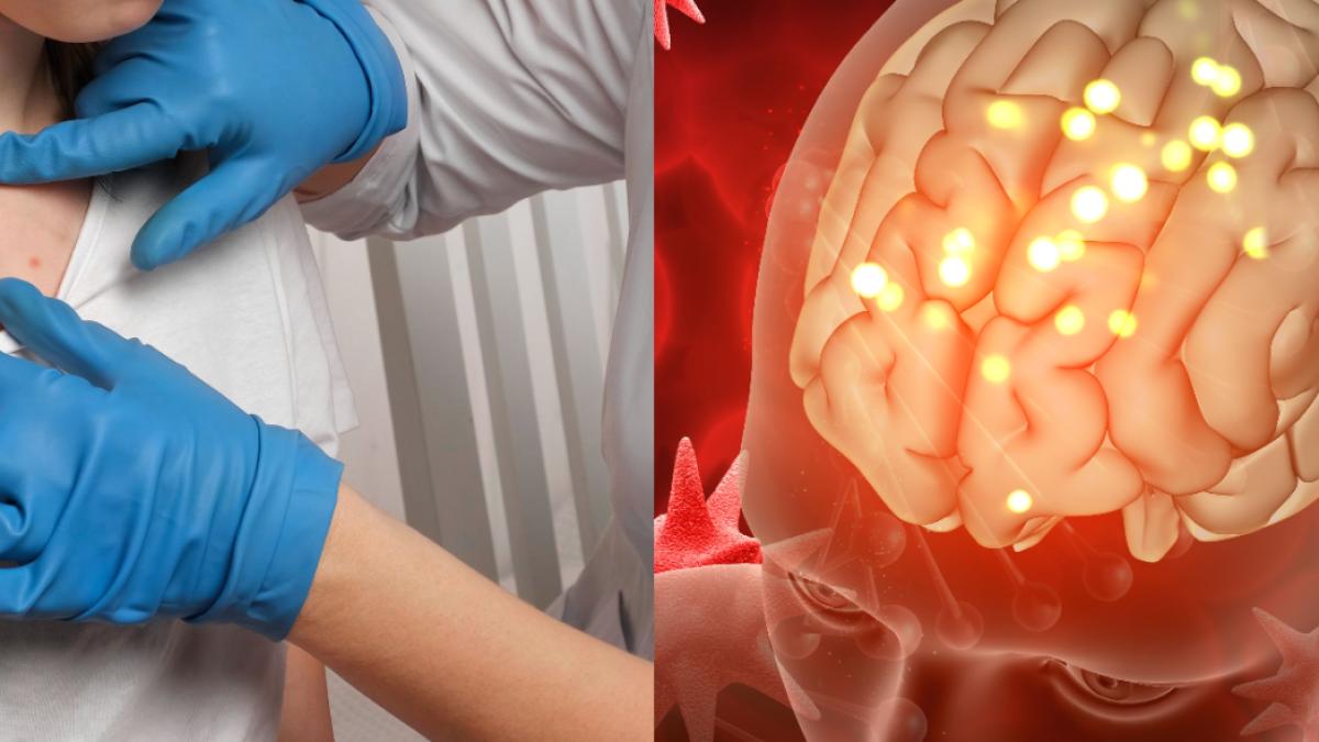 varicela--factor-de-risc-pentru-accidentul-vascular-cerebral--riscul--triplu-pentru-cei-sub-40-de-ani_88390200