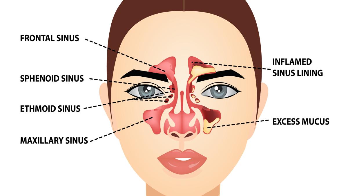 sinuzita--cauze--simptome--tratament-trebuie-10-14-zile-ca-sa-tratezi-cu-adevarat-inflamatia--sinuzita-cronica-poate-dura-si-cativa-ani_53740600
