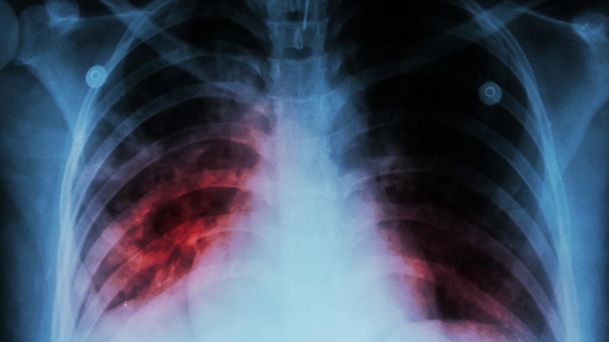 pneumonia-interstitiala-cauze--simptome--tratament--la-ce-sa-fii-atent-cand-tusesti-si-respiri_92506600