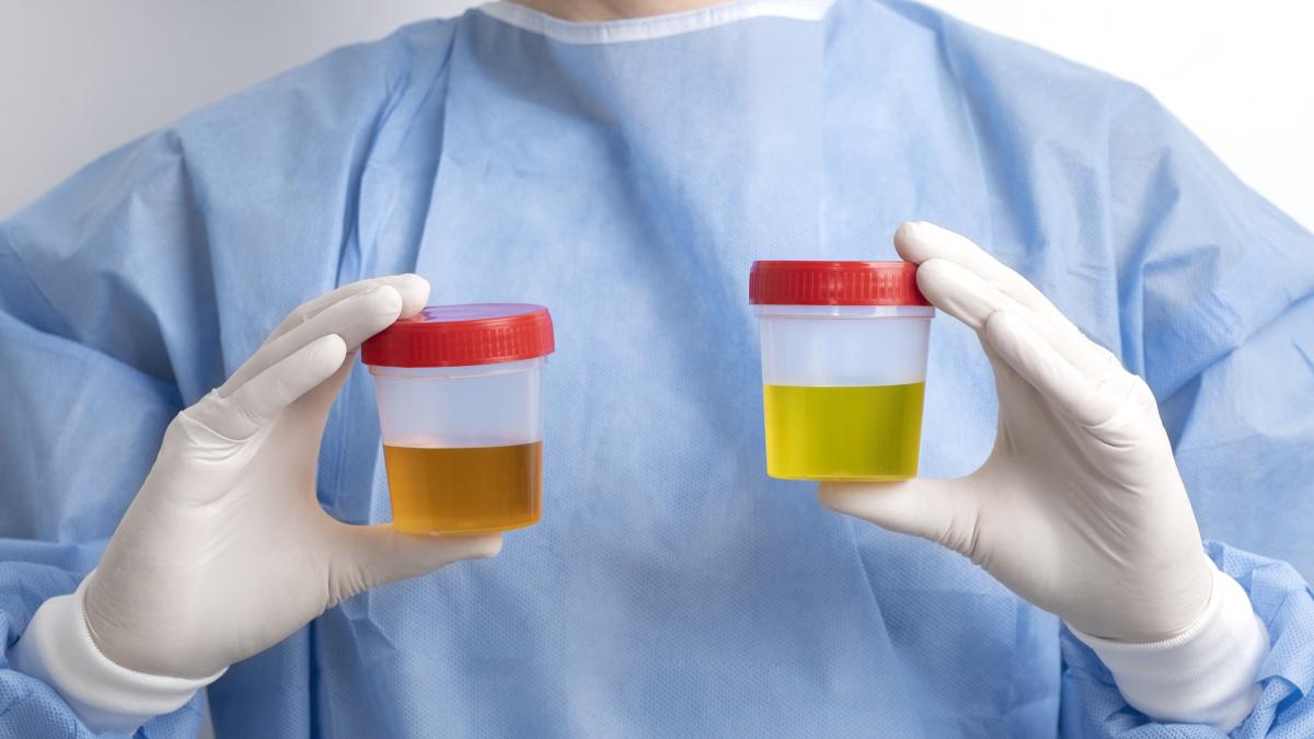 cancer-renal-primul-semn-pe-care-multi-il-ignora--dijmarescu-poate-aparea-de-la-o-banala-infectie-urinara--poate-fi-si-rezultatul-unor-tumori-avansate_22135200