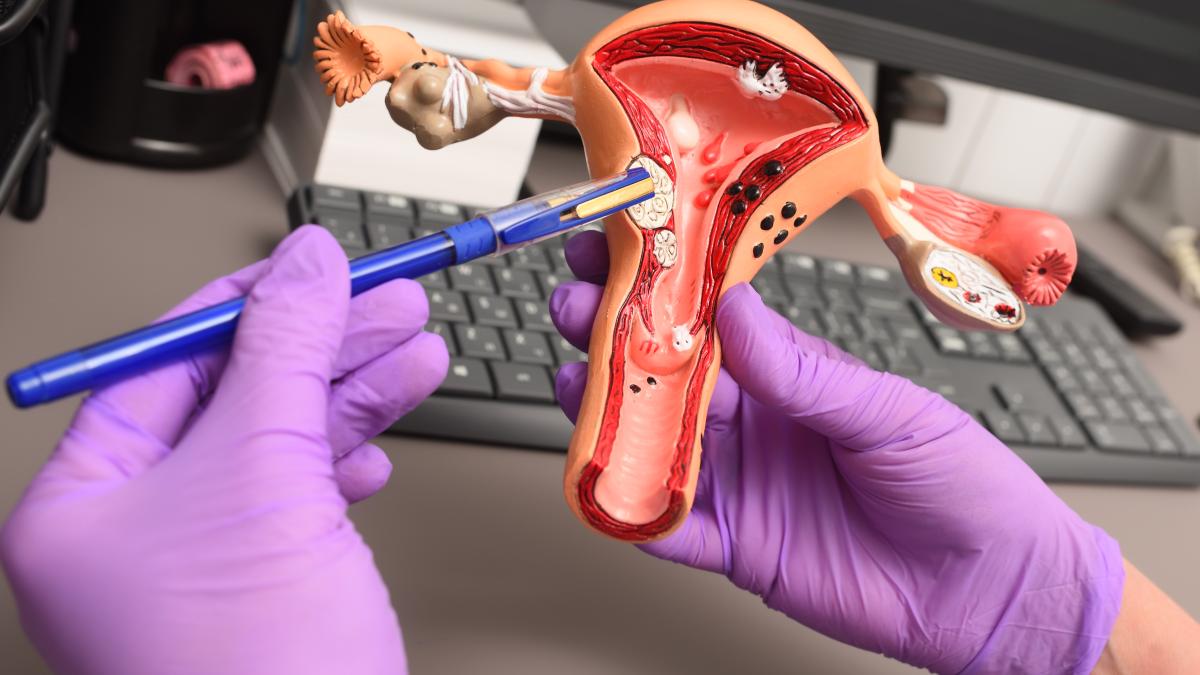 cancerul-de-col-uterin--tratament_31870800