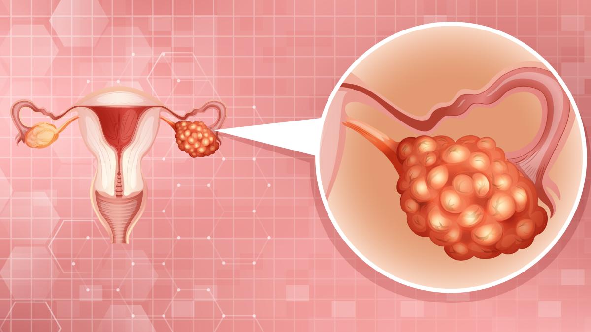 chist-ovarian-simptome-si-tratament--dijmarescu-rmn-ul-va-arata-daca-este-un-chist-malign--belign-sau-inflamator_75914100