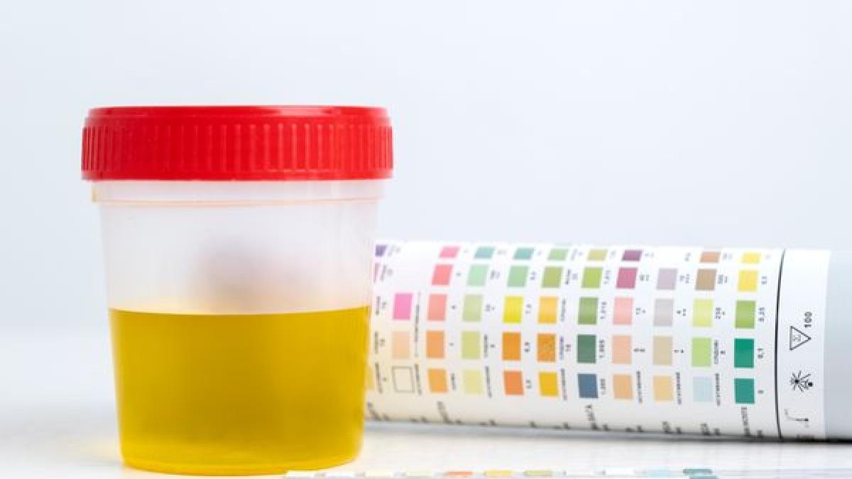 cancerul-de-vezica-urinara--depistat-cu-12-ani-mai-devreme-printr-un-nou-test-de-urina--afecteaza-1-din-28-barbati_30158200