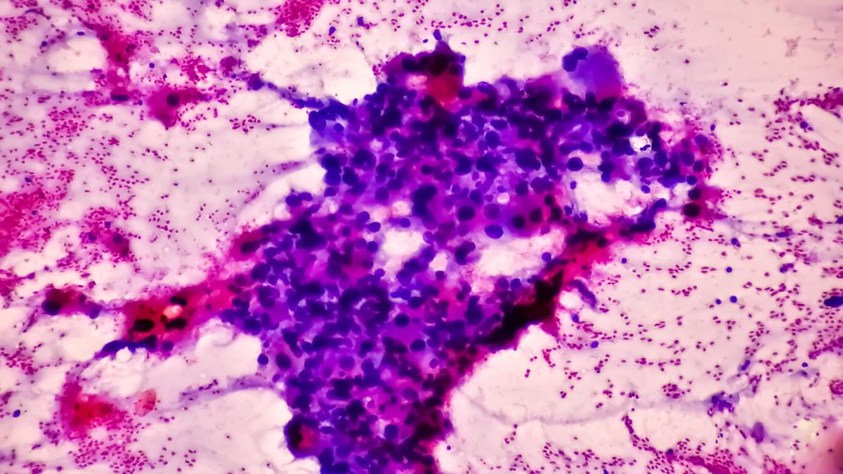 factorii-care-ne-imbolnavesc-de-cancer_30421800