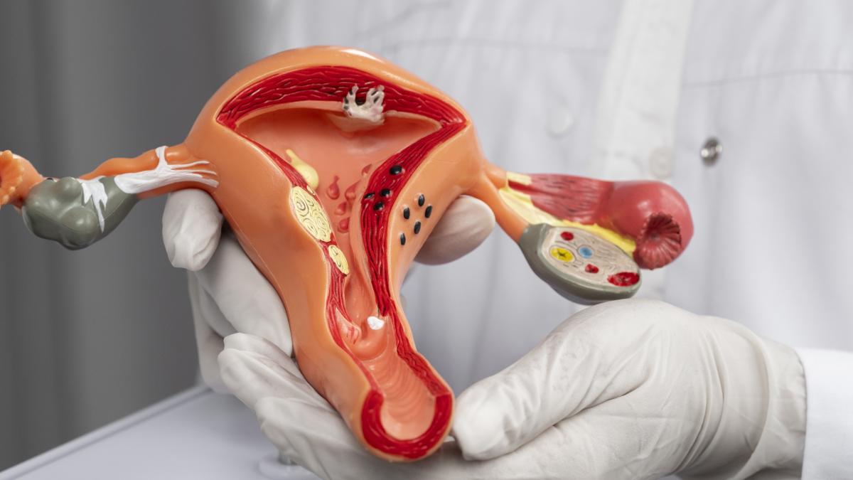 cancerul-de-col-uterin--asociat-cu-subdezvoltarea_26746200