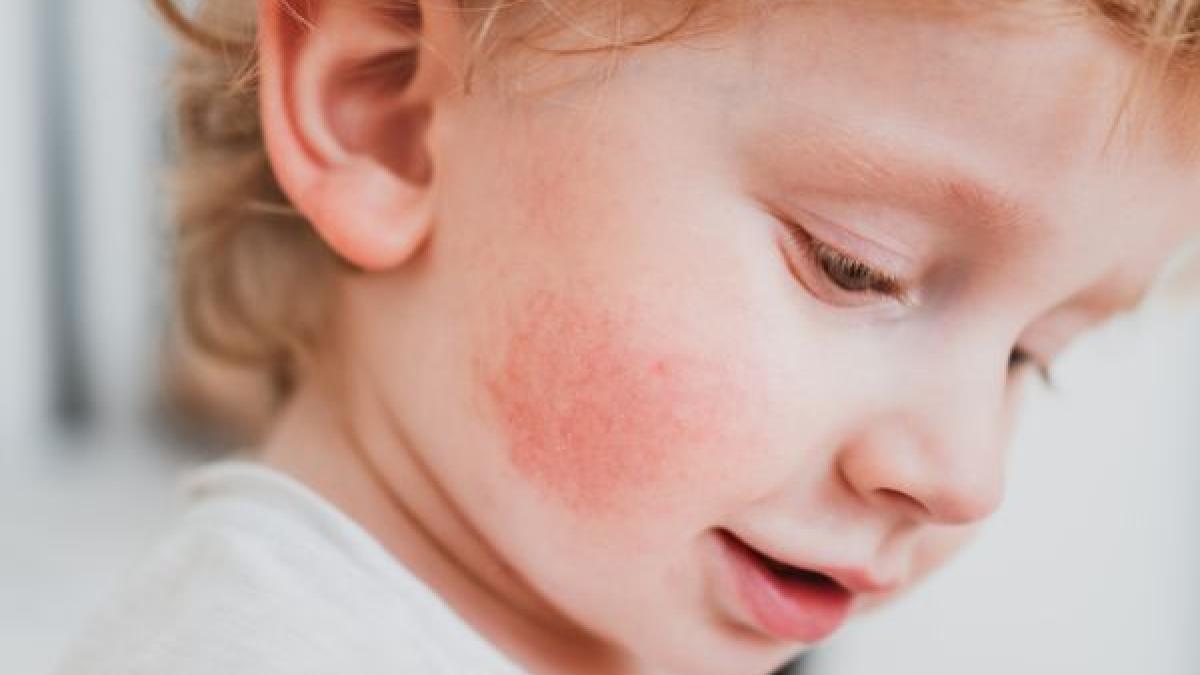 dermatita-atopica--boala-complexa--antonescu-as-putea-sa-o-compar-cu-un-cameleon_17591100