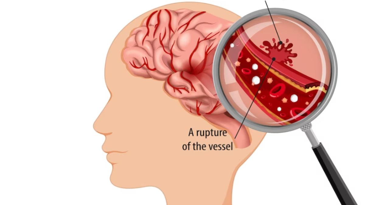 accidentul-vascular-cerebral-ischemic-simptome--tratament--ce-este-trombectomia--toader-bolnavul-scapa-cu-viata--rezultate-bune-in-primele-12-ore-de-la-debutul-bolii_81572700