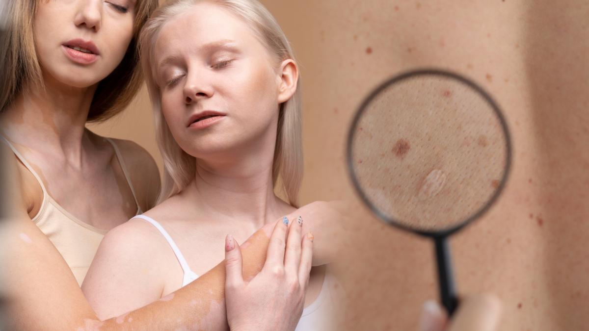 cancerul-de-piele--proportii-inspaimantatoare--care-e-principala-cauza--ioan-lascar-e-agresiva-acum-operez-saptamanal-cateva--in-urma-cu-cativa-ani-vedeam-1---2-pe-luna_70447200