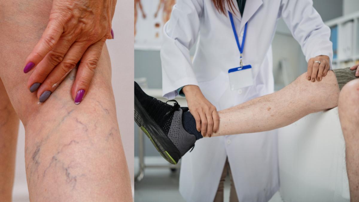 varice-toate-metodele-de-tratament-si-recuperare--ce-trebuie-sa-stie-orice-pacient-care-sufera-de-varice--toni-feodor-nu-presupune-durere--cuvintele-potrivite-pot-fi-cel-mai-bun-medicament_68749200