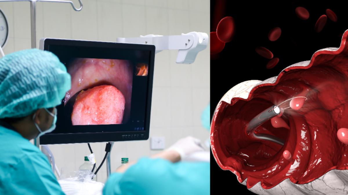 colonoscopia-varsta-cand-trebuie-facuta-si-la-ce-interval-de-timp--atentie-daca-ai-peste-45-de-ani--martian-sfantul-screening-pentru-cancerul-de-colon-si-cancerul-colorectal_26834600