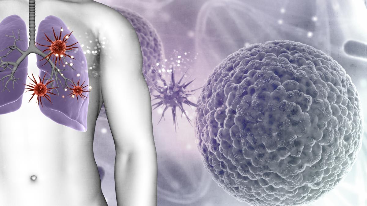 testul-care-iti-arata-daca-ai-cancer-pulmonar-_56822100