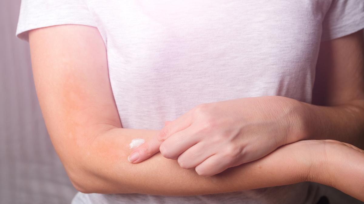 neurodermatita--boala-de-piele-cronica_43825000