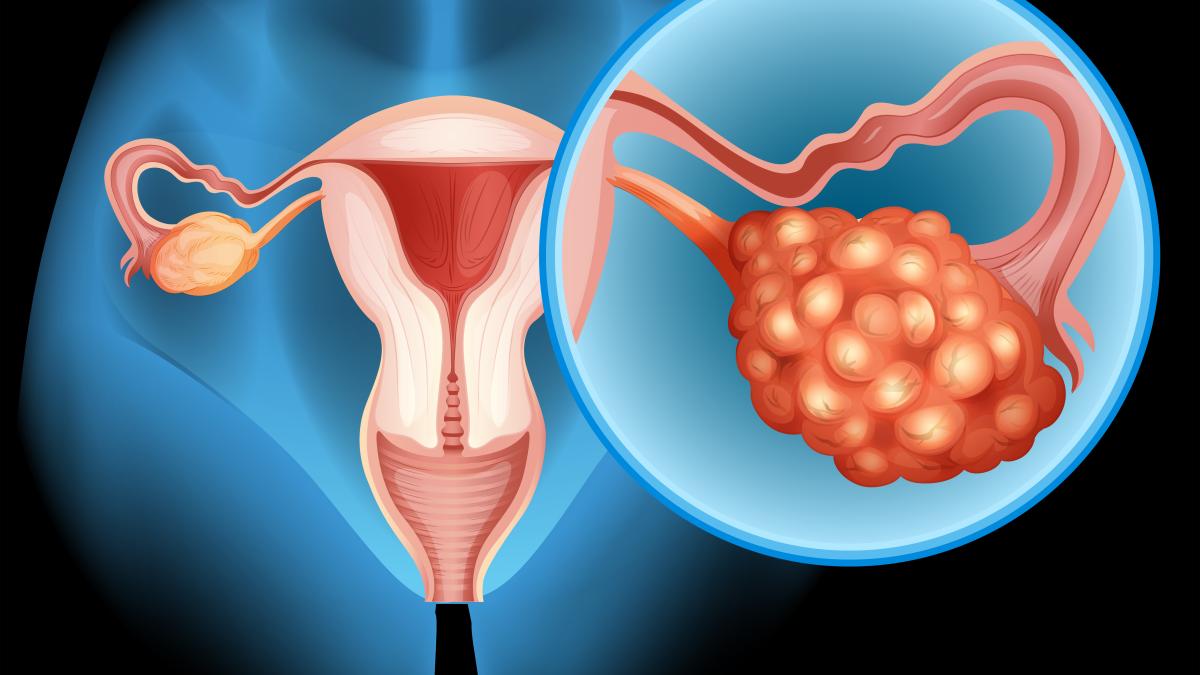 fibroamele-uterine--tumorile-necanceroase-ale-uterului-_35777200