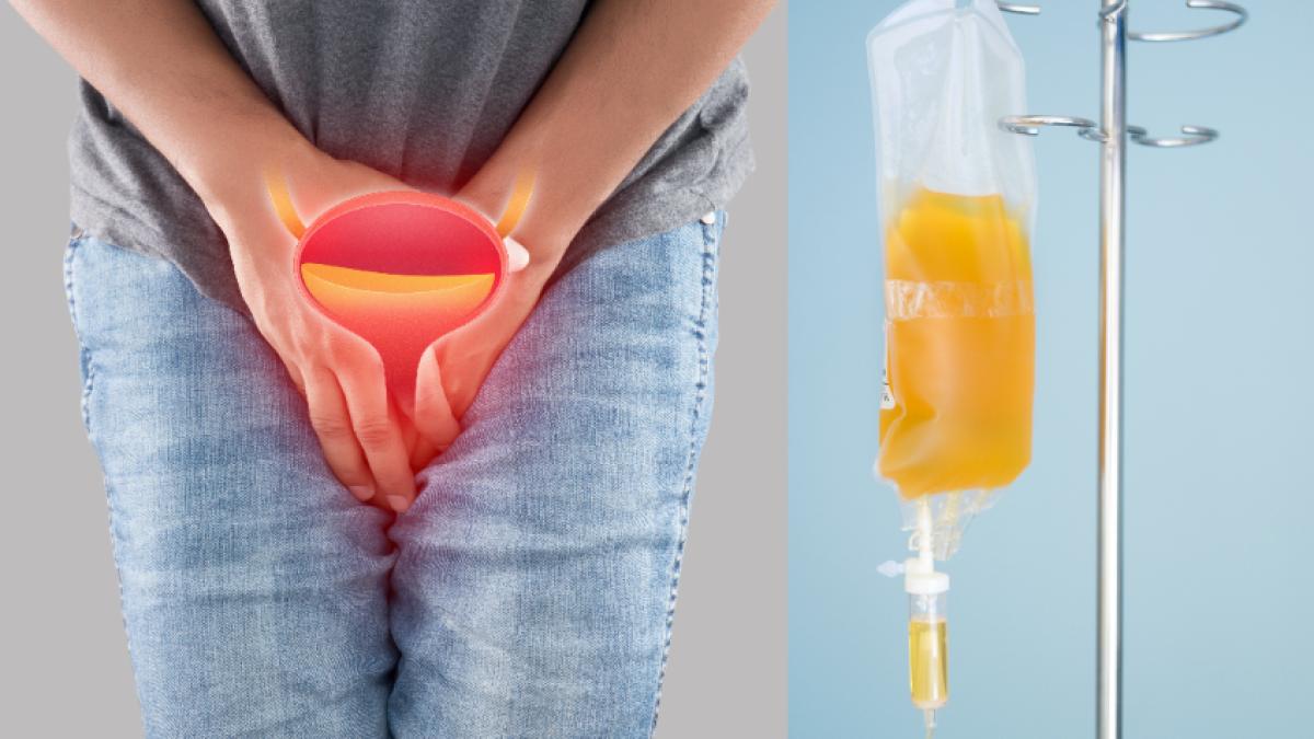 sonda-urinara-ce-rol-are--cand-se-pune--cat-timp-trebuie-sa-o-tii--dumitrache-pietrele-se-formeaza-si-in-vezica--nu-doar-in-rinichi_27950200
