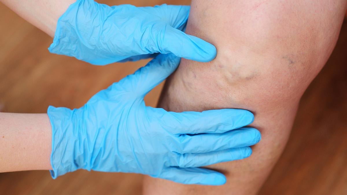 tromboflebita--cauze--simptome-si-tratament--poate-duce-la-embolie-pulmonara-sau-avc_51369100