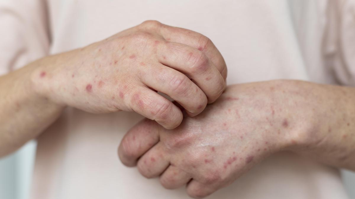fitofotodermatita--boala-gradinarilor--care-sunt-simptomele-si-cand-este-necesar-sa-mergeti-la-medic_93834300