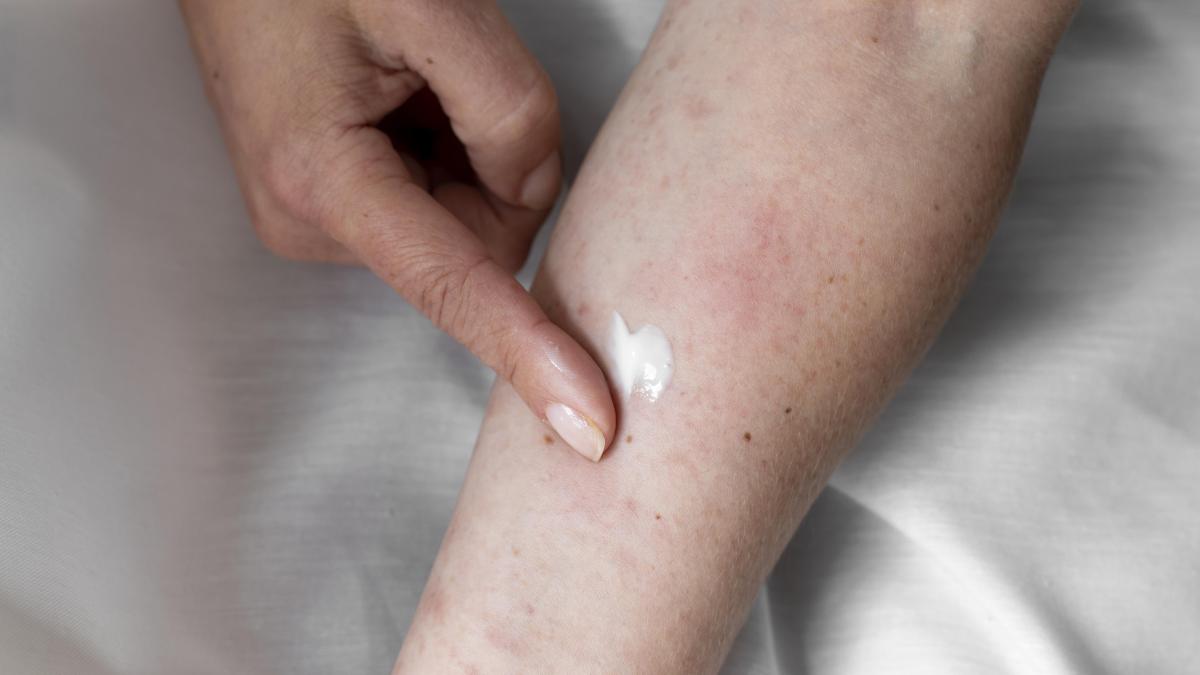 ce-trebuie-sa-stii-despre-muscaturile-de-purici_22826200