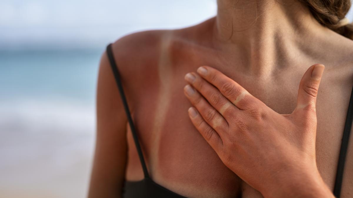 cum-tratezi-arsurile-solare--care-este-cel-mai-important-pas-pe-care-trebuie-sa-il-faci-pentru-a-le-evita_68804600
