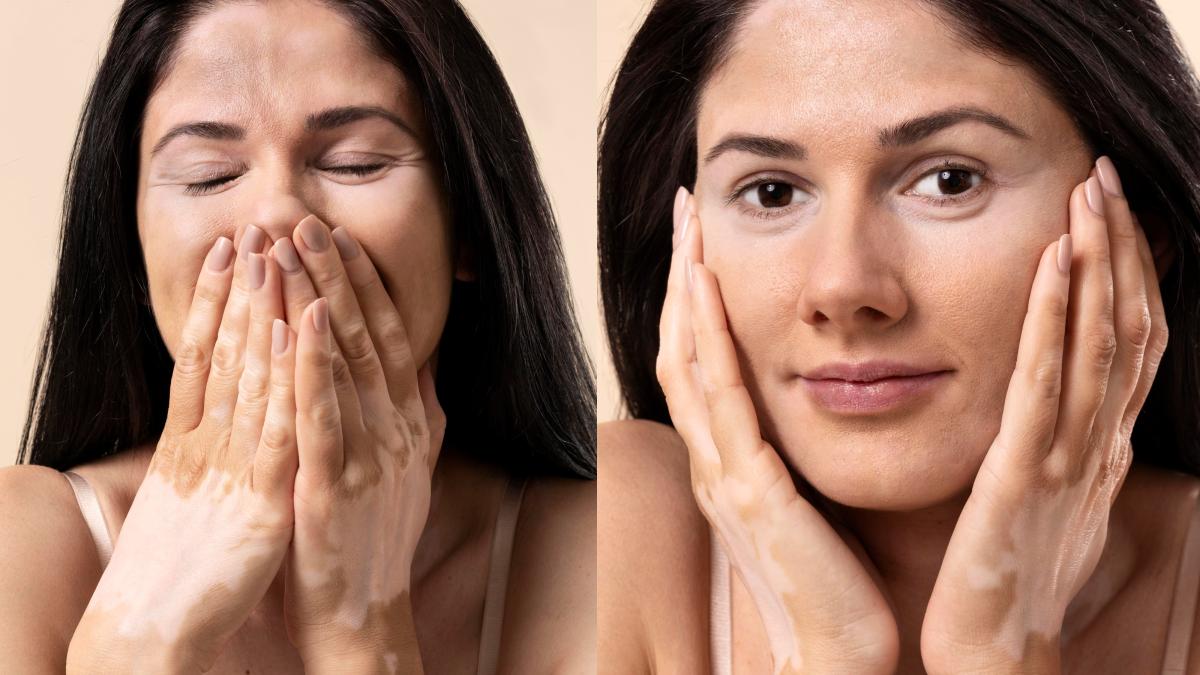 vitiligo-tipuri-si-simpome--cauza-care-declanseaza-vitiligo-si-cum-se-poate-trata-de-obicei--petele-sunt-permanente_50201600