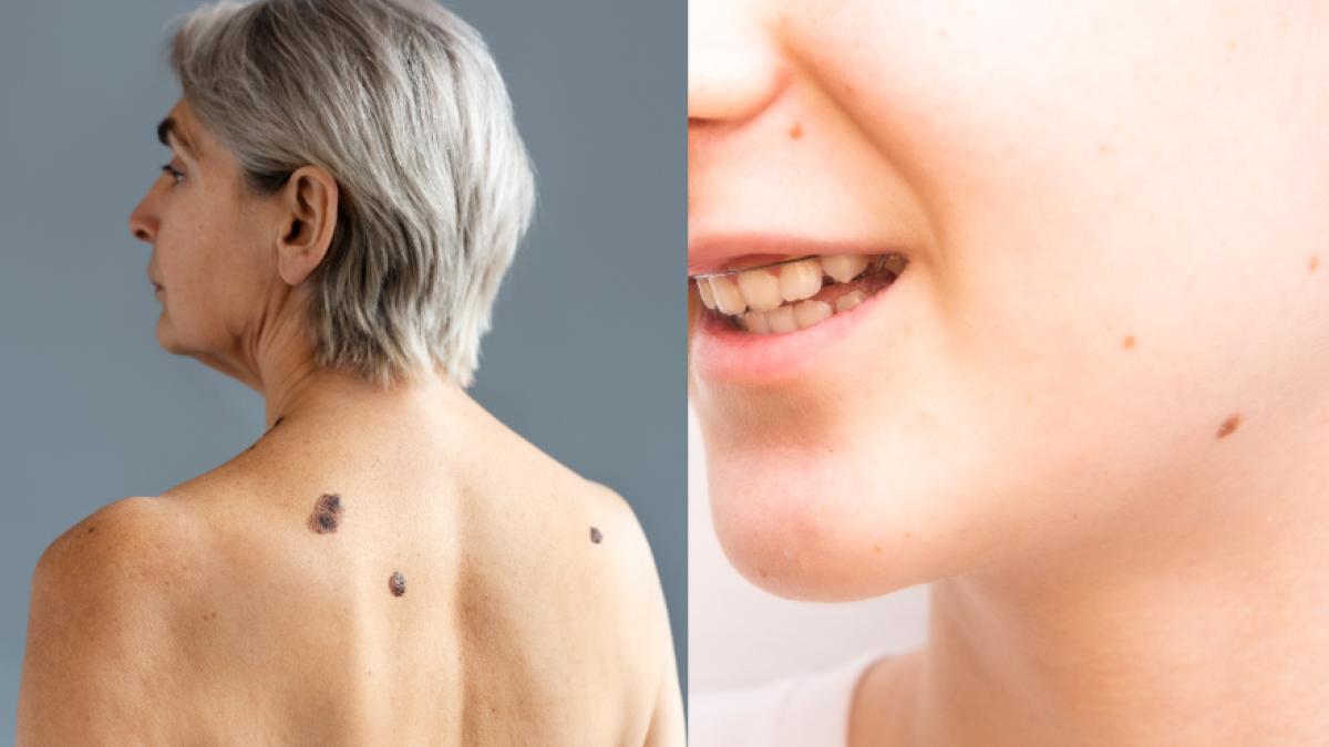 cum-deosebesti-o-alunita-sanatoasa-de-o-alunita-periculoasa--cum-recunosti-un-melanom--mihaela-leventer-evolueaza-tacut--fara-simptome_42256100