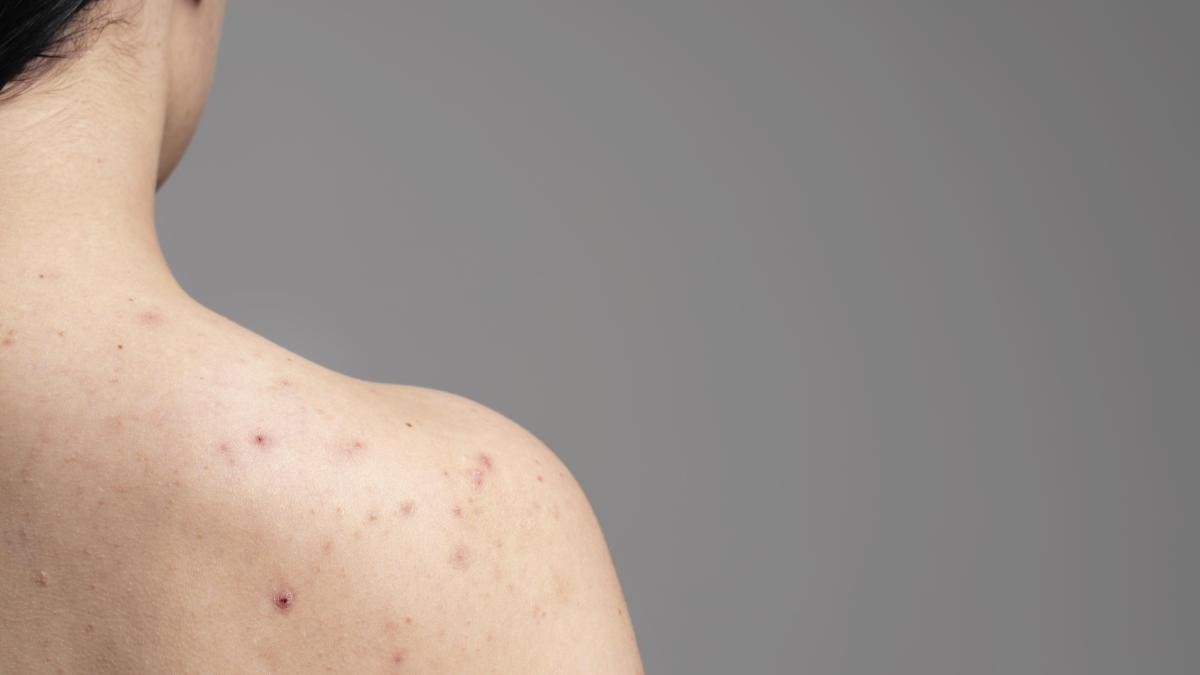 cosurile-de-pe-corp-cauze--tratamente--preventie--daca-iti-storci-cosurile--poti-cauza-chisturi-sub-piele-si-infectii-mai-grave_47172000