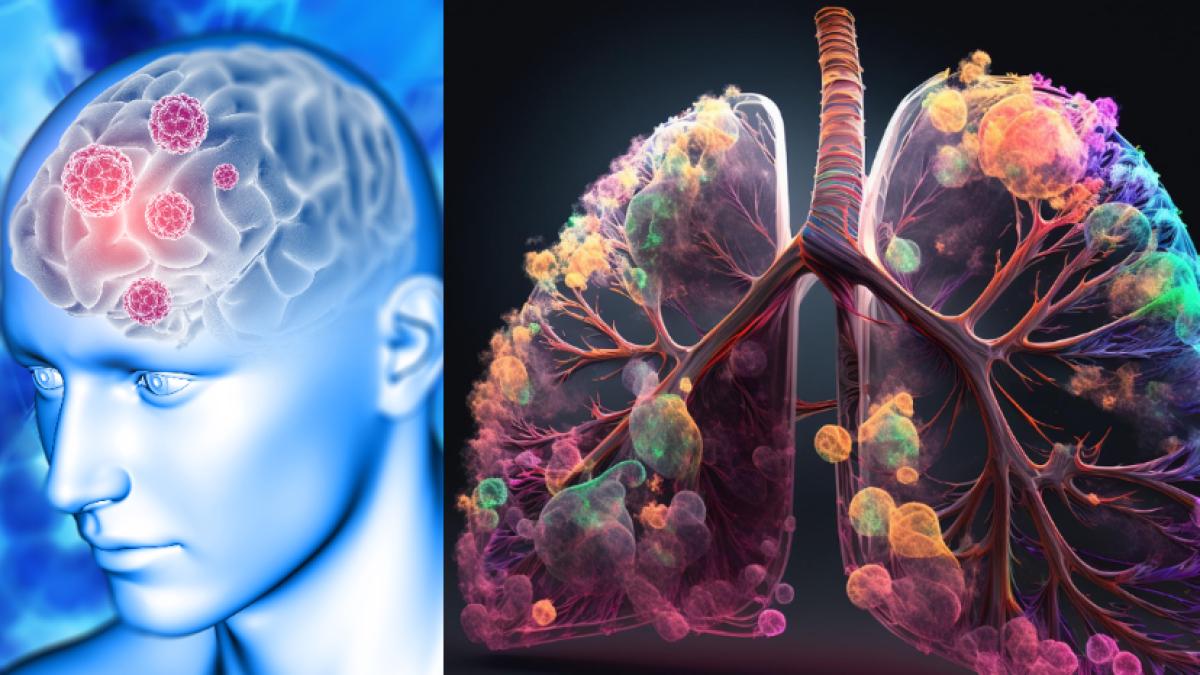 cancerul-pulmonar--cel-mai-agresiv-cancer--avanseaza-rapid-la-creier--oase-si-inima--da-metastaze-in-tot-corpul--testele-care-pun-diagnosticul_02337400