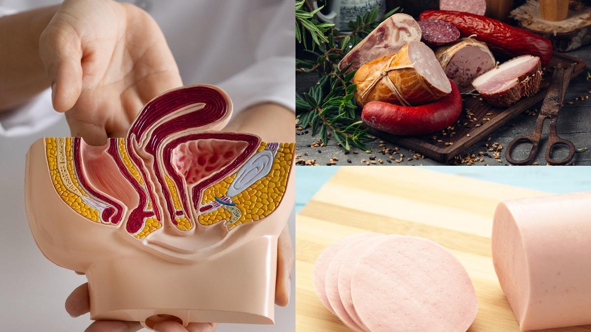 cancerul-de-colon--rezultat-al-dietei-zilnice_27578600