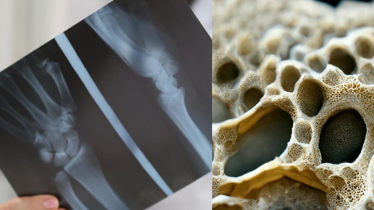 osteoporoza-boala-sistemului-osos_72839200