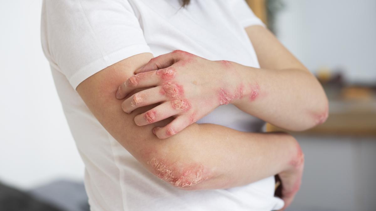 dermatita-seboreica-simptome--cauze--tratament--cum-sa-o-depistezi-si-cand-sa-mergi-la-doctor_53579600
