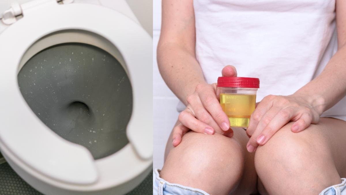 cancer-urologic-primul-simptom--semnul-la-care-sa-fii-atent-imediat-ce-urinezi--bogdan-parliteanu-daca-vezi-asta-e-semnal-de-alarma_14811500