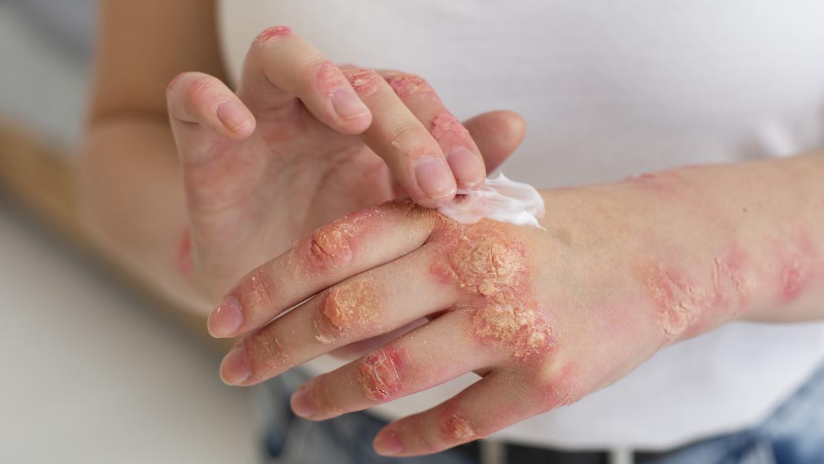 psoriazisul--boala-subdiagnosticata-din-cauza-rusinii_92989100
